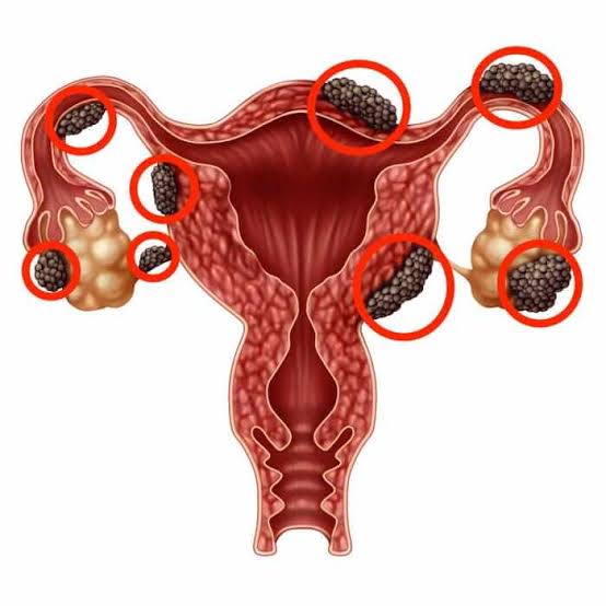 Gynecological Conditions Management