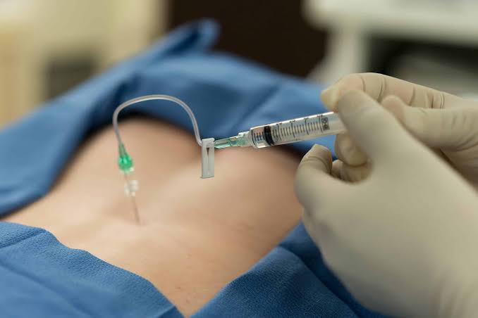 Epidural Steroid Injections