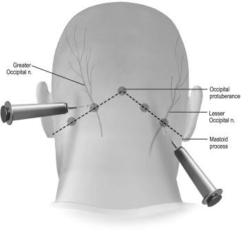 Migraine Treatment