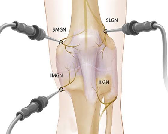 Radiofrequency Ablation